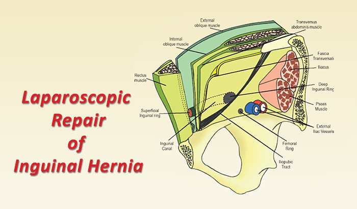 Laparoscopic Anatomy Of Inguinal Hernia - vrogue.co