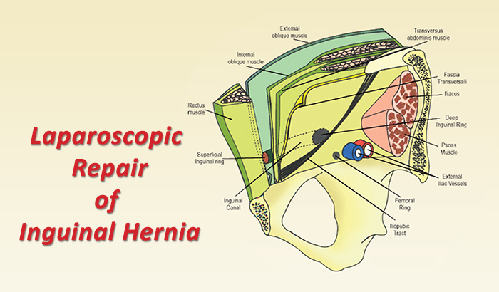Laparoscopic Inguinal Hernia Repair Triangle Of Doom PTJCCV